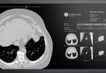 intelligenza artificiale polmonare