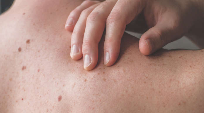 Intelligenza artificiale melanoma Università di Göteborg