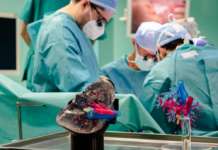 Trapianto di fegato con modello in 3D al Niguarda di Milano trapianto fegato