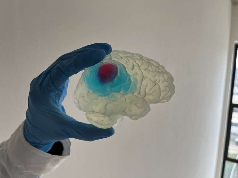 Un cervello in stampa 3D per curare i tumori cerebrali