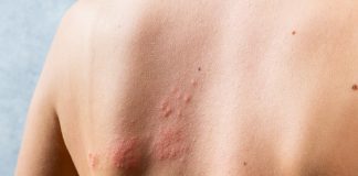 Differenze fenotipiche della dermatite atopica suddivise per età Dermatite atopica e creme lipidiche