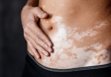 Terapie topiche per la vitiligine in pazienti pediatrici e adolescenti: i consigli degli esperti Ritlecitinib orale nel trattamento della vitiligine non segmentale