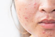 Rosacea, microbioma e probiotici: l’asse intestino-pelle Uso dei PROMs negli studi clinici su acne e rosacea