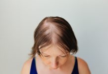 Alopecia androgenetica femminile, un aggiornamento sul trattamento Donne con alopecia areata: esiti autoimmuni, infiammatori, tiroidei e psichiatrici nei figli