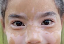 Inibitori topici della calcineurina e metabolismo dei bambini affetti da vitiligine Inibitori topici della calcineurina e metabolismo dei bambini affetti da vitiligine