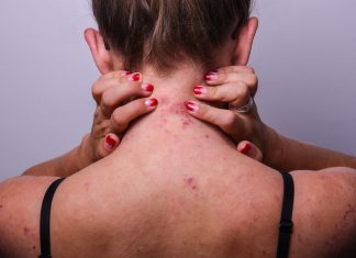 Dermatite allergica da contatto: l’impatto dello stress Dermatite atopica e trattamenti topici: benefici e potenziali danni