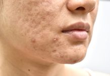 Associazione tra acne e acidi grassi insaturi: prove cliniche e genetiche Acne, sicurezza ed efficacia dei nutraceutici