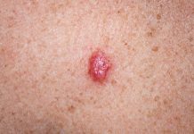 Tumori della pelle non-melanoma: il punto sui trattamenti Tumori della pelle non-melanoma: il punto sui trattamenti