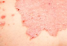 Nuovi trattamenti per la psoriasi: un aggiornamento sul fronte terapeutico Nuovi trattamenti per la psoriasi: un aggiornamento sul fronte terapeutico