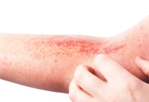 Strategie di counseling nella dermatite atopica: qual è il miglior modo per integrarla nella pratica clinica dermatologica? Strategie di counseling nella dermatite atopica: qual è il miglior modo per integrarla nella pratica clinica dermatologica?