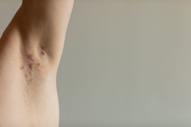 Idrosadenite suppurativa e psoriasi: percorsi patogenetici comuni