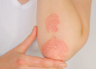 Psoriasi e idrosadenite suppurativa, al congresso EADV le evidenze su bimekizumab Disturbi metabolici e psoriasi: il ruolo degli interventi nutrizionali