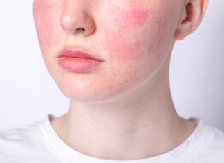 Rosacea: l’impatto dell’esposoma Trattamento della rosacea neurogena: una revisione della letteratura