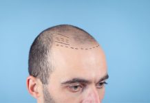 Trapianto di capelli: la dimensione psicologica Trapianto di capelli: la dimensione psicologica