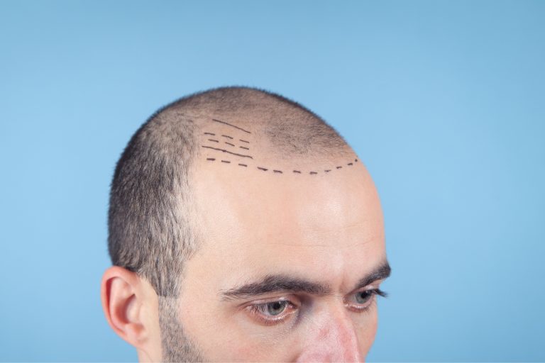 Trapianto di capelli: la dimensione psicologica