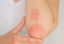 Psoriasi, l’11 marzo visite e consulenze gratuite negli ospedali con il Bollino rosa Psoriasi, l'11 marzo visite e consulenze gratuite negli ospedali con il Bollino rosa