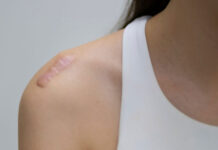 Evidenze genomiche ed epigenetiche delle cicatrici cheloidi