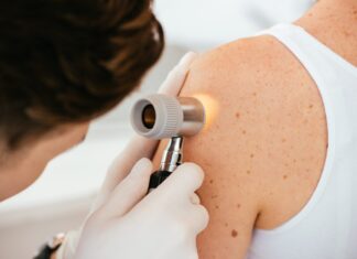 Melanoma, come risconoscerlo: 5 consigli Melanoma, come riconoscerlo: 5 consigli