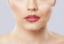 Cicatrici atrofiche da acne: caratteristiche predittive della microscopia confocale a riflettanza Cicatrici atrofiche da acne: caratteristiche predittive della microscopia confocale a riflettanza