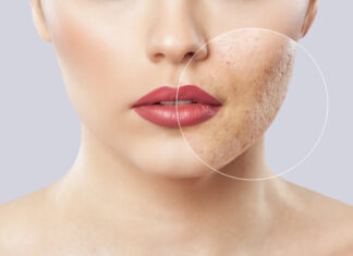 Cicatrici atrofiche da acne: caratteristiche predittive della microscopia confocale a riflettanza Cicatrici atrofiche da acne: caratteristiche predittive della microscopia confocale a riflettanza