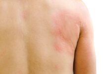 Orticaria cronica spontanea: per i pazienti costi per oltre 4mila euro l’anno Orticaria cronica spontanea: per i pazienti costi oltre 4mila euro l'anno