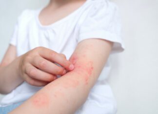 Dermatite atopica: upadacitinib rimborsabile agli adolescenti dai 12 anni di età Dermatite atopica: upadacitinib rimborsabile agli adolescenti dai 12 anni di età