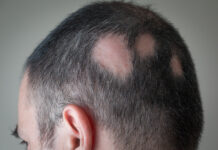 Alopecia areata grave: nuovo consenso sul trattamento nell’adulto Alopecia areata grave: nuovo consenso sul trattamento nell'adulto