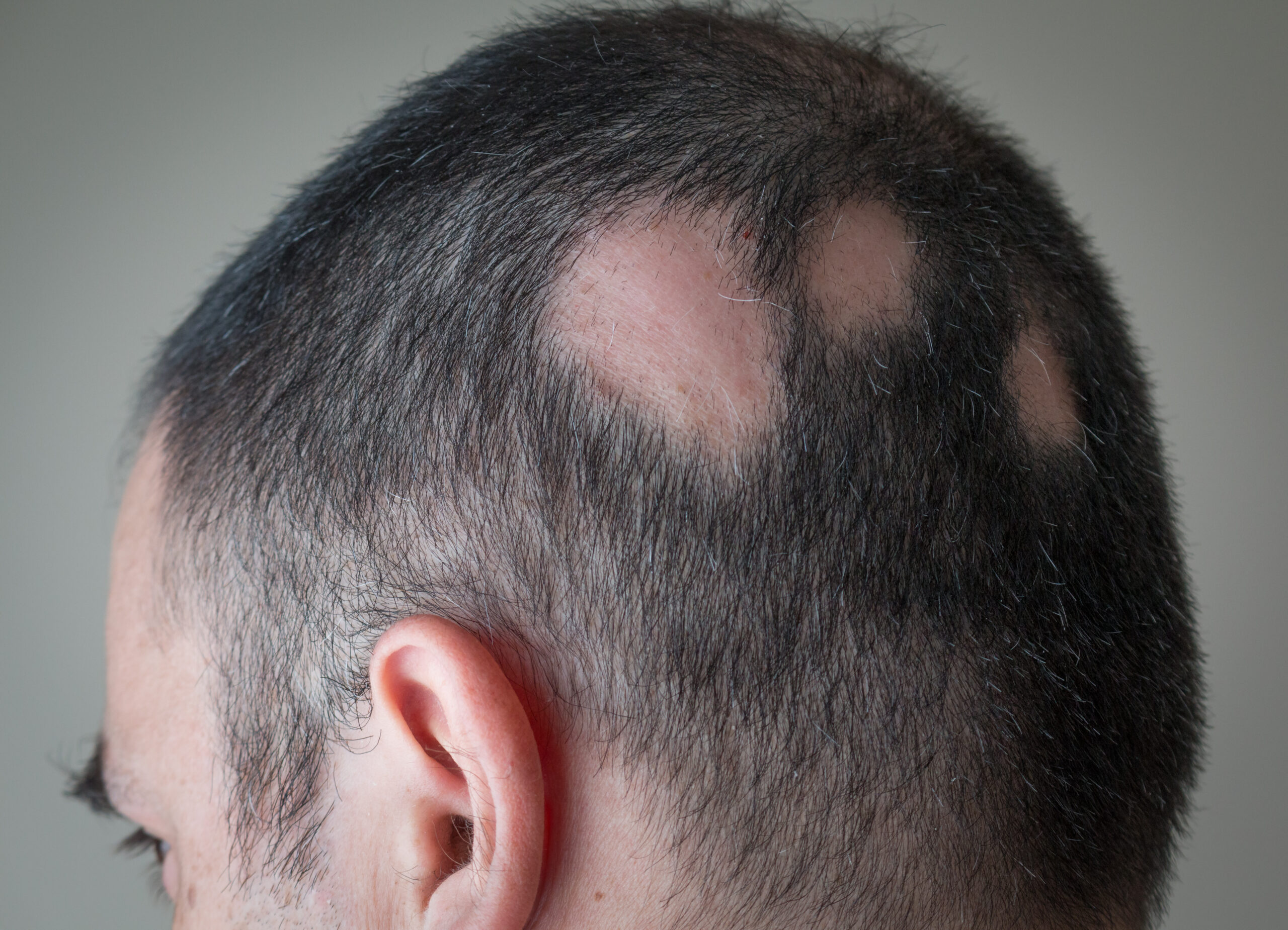 Alopecia areata grave: nuovo consenso sul trattamento nell'adulto Alopecia areata grave: nuovo consenso sul trattamento nell'adulto