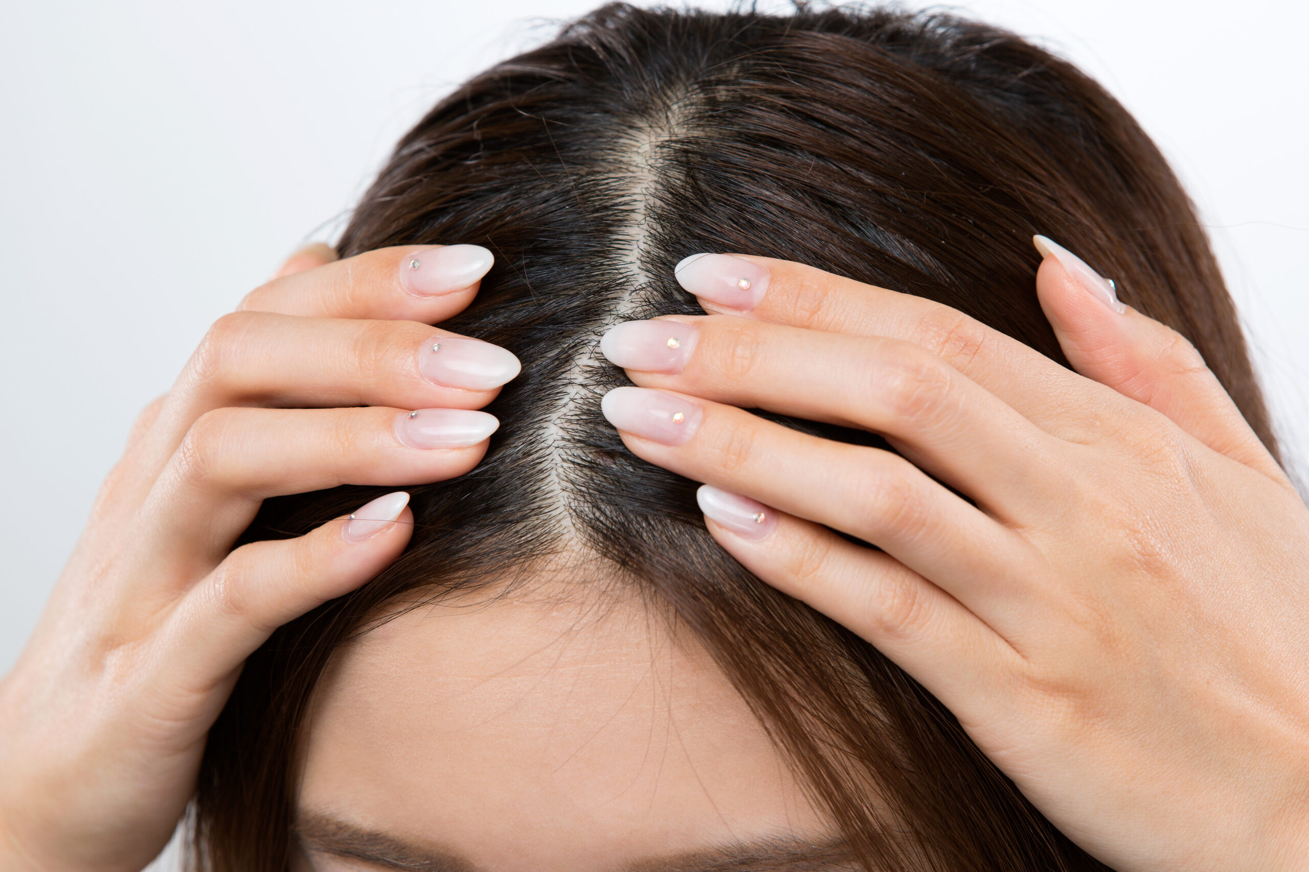Melanoma al cuoio capelluto e alle unghie: come riconoscerlo Melanoma al cuoio capelluto e alle unghie: come riconoscerlo