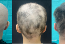Alopecia areata grave: nuovo consenso sul trattamento nell’adulto