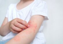 Dermatite atopica, torna la campagna Sidemast: consulti dermatologici gratuiti Dermatite atopica, torna la campagna Sidemast: consulti dermatologici gratuiti