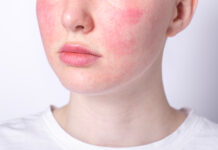 Rosacea, la dermocosmesi accanto alla terapia: un protocollo per fasi Rosacea, la dermocosmesi accanto alla terapia: un protocollo per fasi