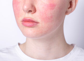 Rosacea, la dermocosmesi accanto alla terapia: un protocollo per fasi Rosacea, la dermocosmesi accanto alla terapia: un protocollo per fasi