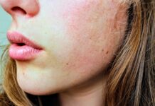 Pelle sensibile: la giusta strategia, dalla skincare ai trattamenti estetici Pelle sensibile: la giusta strategia, dalla skincare ai trattamenti estetici