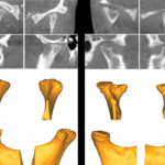 Figg. 1 e 2 Sezioni TC e ricostruzioni 3D dei condili di pazienti affetti da AIG. Da notare la superficie condilare molto irregolare, caratterizzata da zone di crescita osteofitica (a sinistra) ed altre di erosione (a destra).