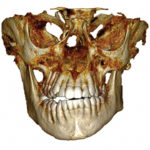 Fig. 4 TC Cone Beam di paziente con AIG monolaterale.