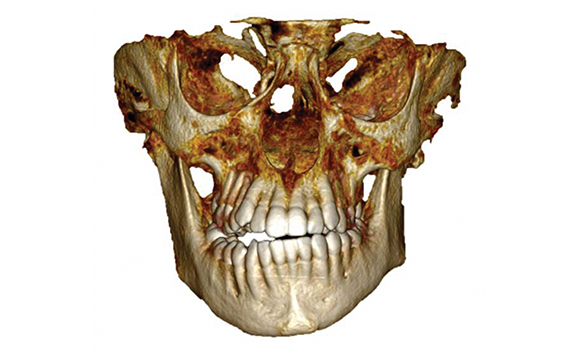 Fig. 4 TC Cone Beam di paziente con AIG monolaterale.