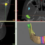 Fig. 5 Mandibola segmentata  di paziente con AIG.