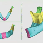 Fig. 6 Mandibola segmentata  di paziente con AIG da diverse  angolazioni.