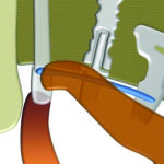 Fig. 4 Rappresentazione schematica della saldatura di una barra di titanio a diverse tipologie di impianto.