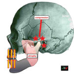 Fig. 1 In mancanza dei denti posteriori, le articolazioni temporomandibolari possono andare incontro a compressione e i muscoli elevatori, mancando di funzione, vanno incontro a progressiva atrofia.