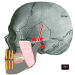 Fig. 2 Se gli elementi dentari posteriori esistono, ma sono in sottoocclusione rispetto alla necessità dell’apparato, la situazione è assimilabile alla mancanza di denti.