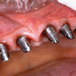 Fig. 3 Aspetto delle mucose attorno a numerosi impianti tutti inseriti subito dopo estrazione di elementi dentari affetti da parodontite grave.