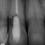 fig. 1 Elemento con perforazione disto-palatale.