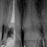 fig. 2 Ritrattamento e medicazione con MTA.