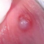 Fig. 1 Lesione tondeggiante di circa 1 cm di diametro; la mucosa che la ricopre appare integra e di colorito traslucido, i margini sono iperemici e non ispessiti; è fluttuante alla palpazione.