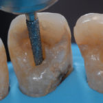 Riabilitazione-endo-restaurativa-06