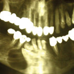Fig. 1 Radiografia ortopanoramica preoperatoria.