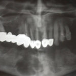 Fig. 12 Ortopantomografia postoperatoria.