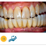 Fig. 13 Visione frontale della riabilitazione ultimata